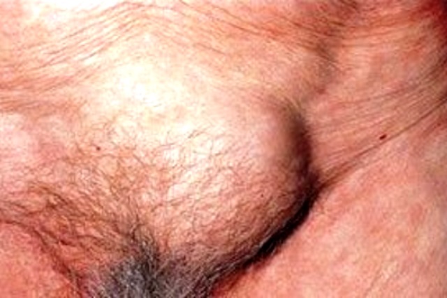 HERNIA INGUINAL