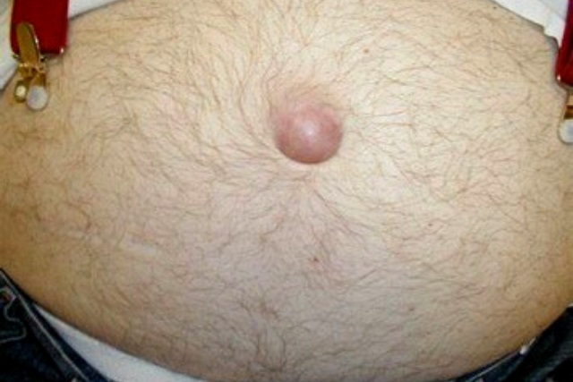 HERNIA UMBILICAL