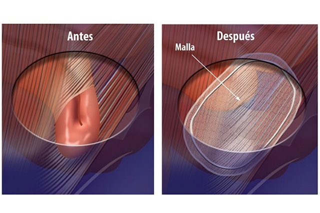 Hernioplastía inguinal con malla