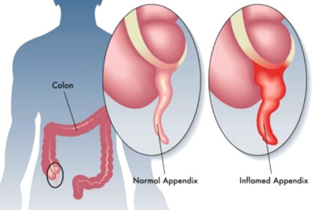 apendicitis aguda