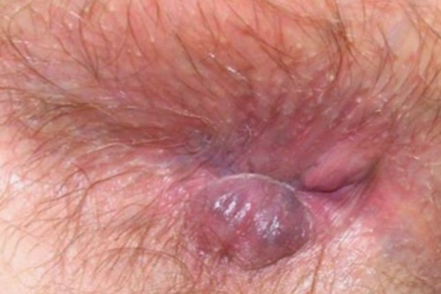 hemorroide externa no complicada